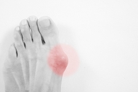 Possible Treatments for Bunions