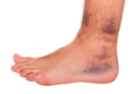 Ligaments Are Affected by Ankle Sprains
