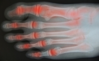 Understanding Psoriatic Arthritis in the Foot