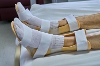 Are Night Splints Helpful for Plantar Fasciitis?