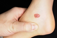 Foot Blood Blisters