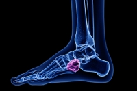 What Area of the Foot Is Affected by Cuboid Syndrome?
