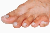Understanding Webbed Toes and Variations