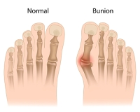 Common Reasons a Bunion Can Develop