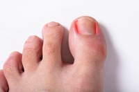 Ingrown Toenails in Athletes